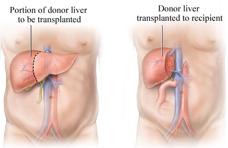 Liver transplant process